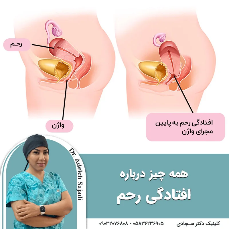 همه چیز درباره افتادگی رحم