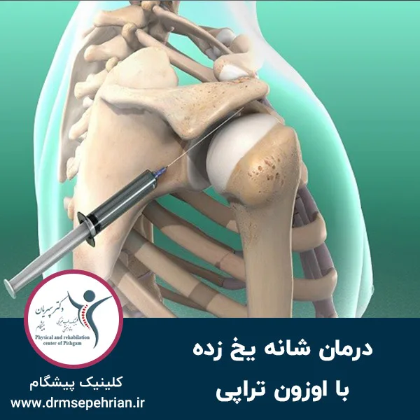 درمان شانه یخ زده با اوزون تراپی