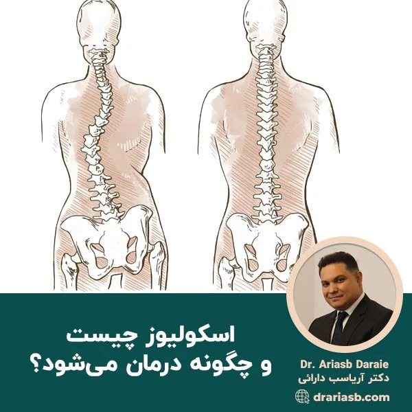 اسکولیوز چیست و چگونه درمان می‌شود؟
