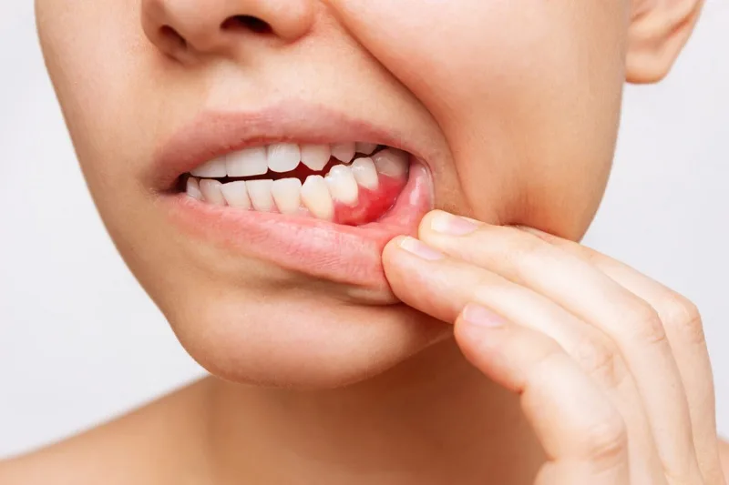 عفونت‌ لثه چیست ؟ درمان و راهکارهای موثر پیشگیری