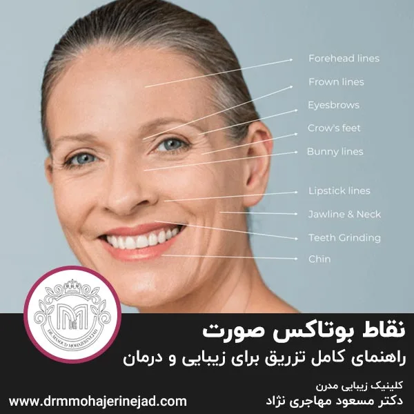 نقاط بوتاکس صورت: راهنمای کامل تزریق برای زیبایی و درمان