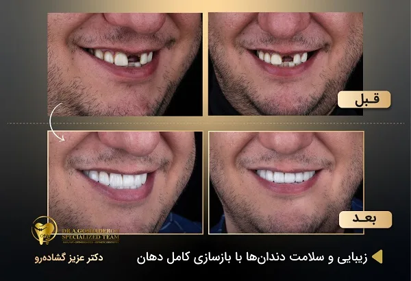بهترین متخصص ایمپلنت در تهران _ دکتر عزیز گشاده رو