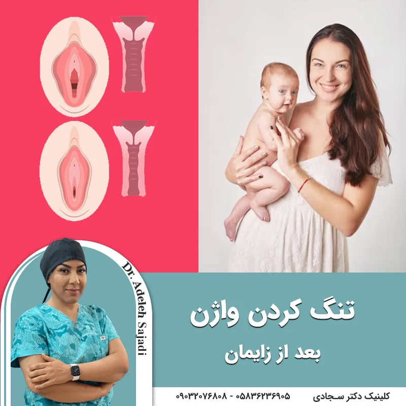 تنگ کردن واژن بعد از زایمان