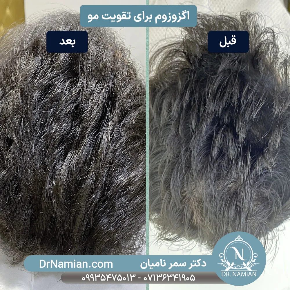 اگزوزوم تراپی مو؛ راه نجات موهای ضعیف و کم پشت