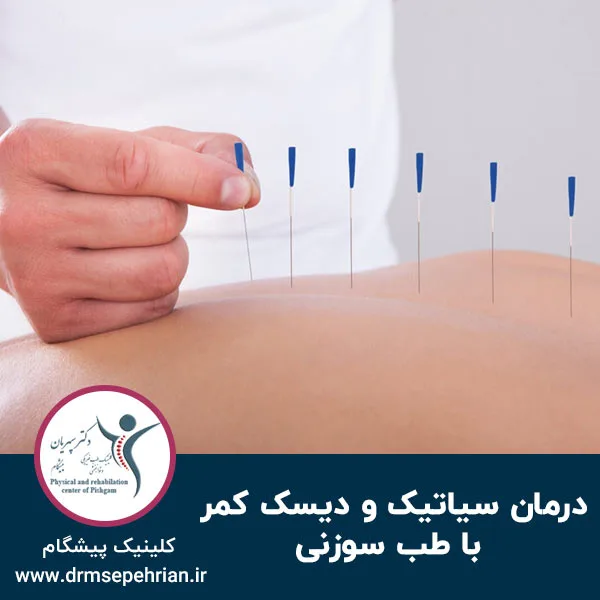 درمان سیاتیک و دیسک کمر با طب سوزنی