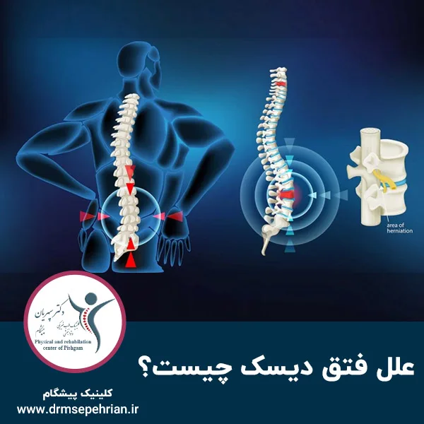 علل فتق دیسک چیست؟