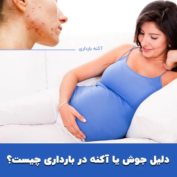 دلیل جوش یا آکنه در بارداری چیست؟
