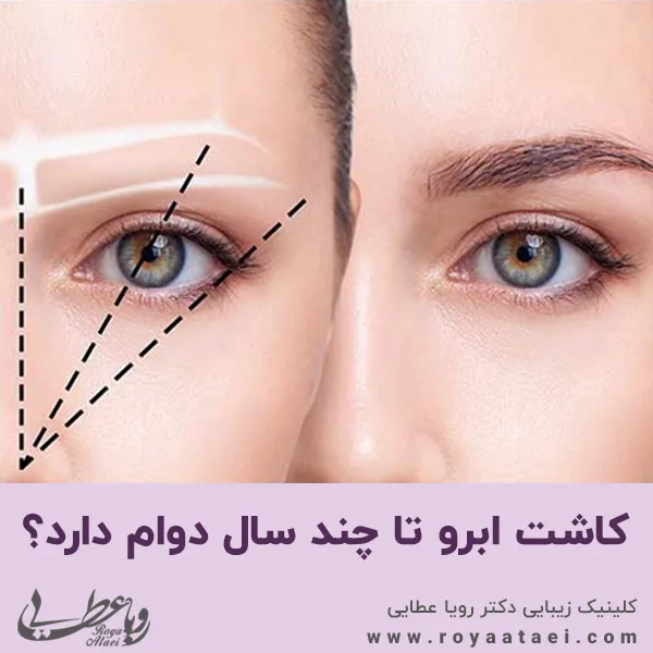 کاشت ابرو تا چند سال دوام دارد؟