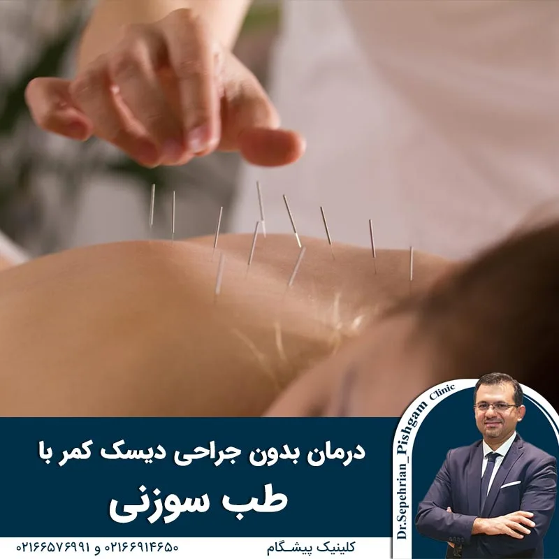 درمان بدون جراحی دیسک کمر با طب سوزنی