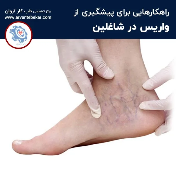 پیشگیری از واریس در شاغلین